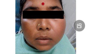 सिम्स में 38 वर्षीय महिला के रेडिकुलर सिस्ट का सफल उपचार